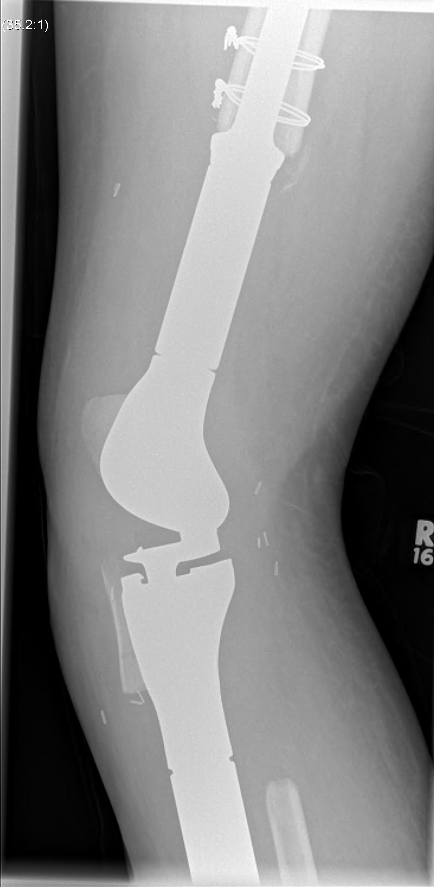 Osteosarcoma Proximal Tibial Resection0002